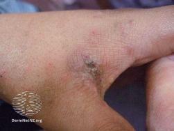 Scabies hand